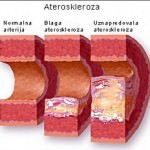 ateroskleroza1